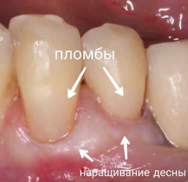 Оголение шейки зуба – причины, лечение.